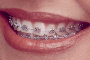 ارتودنسی راهی برای بستن فضاهای بین دندان است