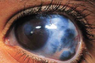 علل و درمان دومین عامل نابینایی درجهان