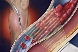 10 نشانه وجود لخته خون در پا را بخوانید