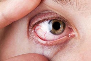 علل ایجاد لکه های خونی داخل چشم