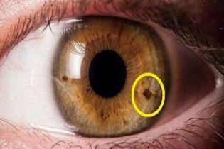 علت لک های درون چشم چیست؟