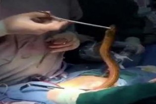 با عمل جراحی یک مار زنده از معده مرد چینی خارج شد