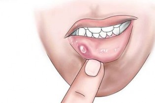 درمان سنتی آفت دهان را بخوانید