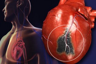 8 دلیل سکته قلبی که کمتر شناخته شده اند