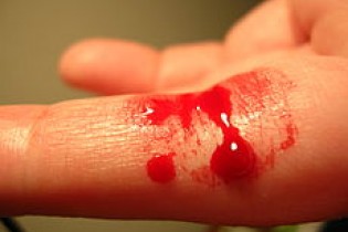 چند روش ساده برای توقف خونریزی‌های کوچک