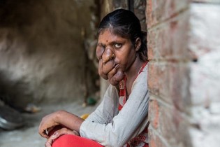 بیماری ژنتیکی عجیب دختر هندی