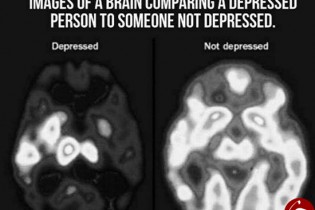 تصویری عجیب از مغز افراد افسرده
