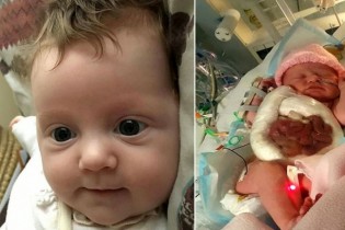 نوزادی که روده اش روی شکمش بود جراحی شد