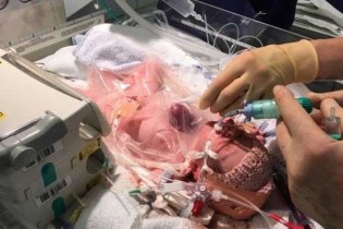 نوزادی که قلبش بیرون از بدنش بود نجات یافت