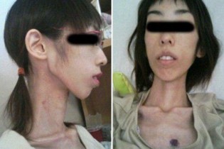 تصاویر / شکنجه دختر جوان با ۱۷ کیلوگرم وزن!