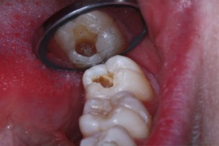 اثرات مخرب دندان خراب بر روی معده