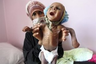روزانه ۱۳۰ کودک یمنی به خاطر گرسنگی می‌میرند