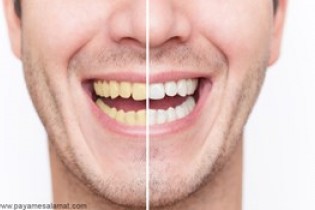 چند روش جالب برای سفید کردن دندان و تقویت لثه ها