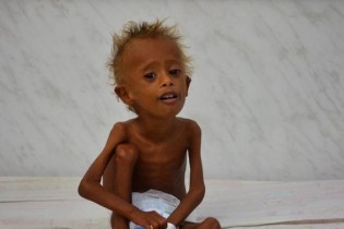 بیش از ۵ میلیون کودک یمنی در خطر گرسنگی