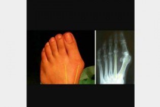آنچه باید در درمان انگشت شست پای منحرف بدانید