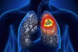 کاهش مرگ‌ومیر ناشی از سرطان ریه با مدل‌های جدید پیش‌بینی