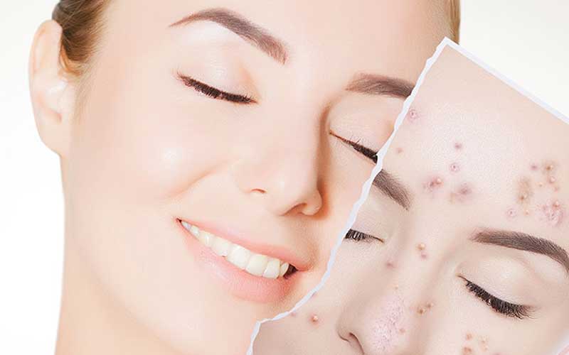 راهکارهایی برای درمان جوش صورت