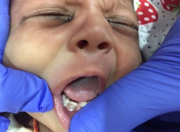 ۷ دندان نوزاد یکماهه هندی کشیده شد