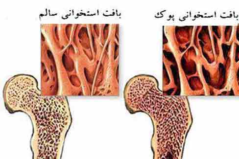 تهدید جدی پوکی استخوان در دختران جوان ایرانی