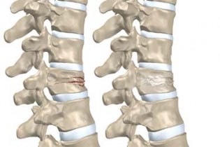 پوکی استخوان در مهره‌های کمر و استخوان لگن