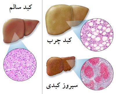 چاقی و اضافه وزن در ابتلا به کبد چرب موثر است