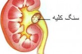 راه های درمان سنگ کلیه را بدانید