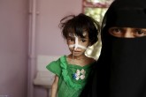 تصاویر دردناک کودکان یمنی حاصل از جنگ