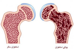 یائسگی زودهنگام با شکستگی استخوان ارتباط دارد