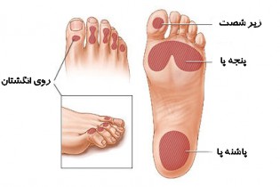 هر 8 ثانیه پای یک نفر به دلیل دیابت قطع می شود