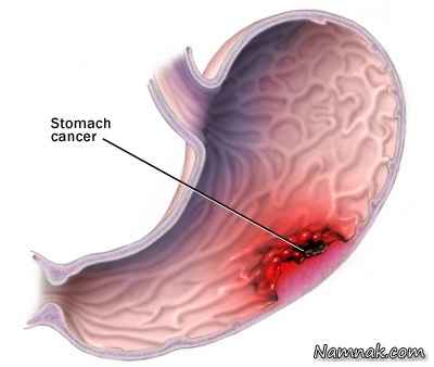 مهمترین علایم هشدار دهنده سرطان معده
