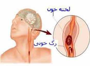 با علائم (TIA) یا سکته مغزی ناقص آشنا شوید