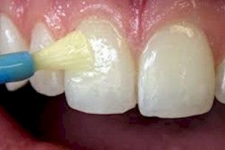 پوسیدگی دندان، نوعی عفونت است
