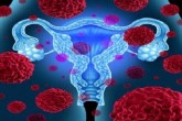 سندروم تخمدان پلی کیستیک خطر مشکلات قلبی زنان را افزایش می دهد