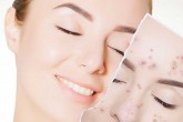 راهکارهایی برای درمان جوش صورت
