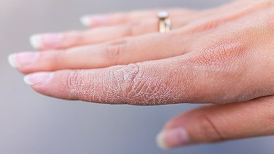۹ پیشنهاد برای درمان خشکی پوست