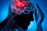 چه درمان‌هایی برای سکته مغزی مناسب هستند؟